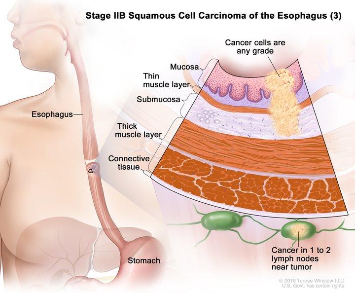 Anatomic illustration of stage 2b esophageal cancer, with pop out of cancer cells in nearby lymph nodes.