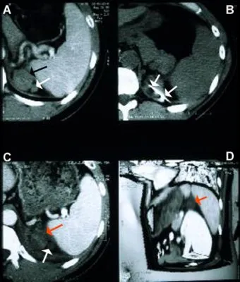 four scans of adrenocortical carcinoma pre and post treatment