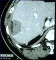 image of carcinoma after treatment