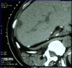 image of carcinoma before treatment