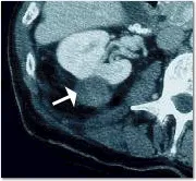 Post-treatment CGT scan of kidney tumor showing complete treatment, seen as eradication of contrast enhancement