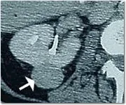 Pre-treatment scan of kidney tumor