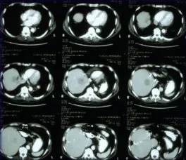 CT scan of the liver before ablation shows large solitary lesion from colorectal carcinoma.