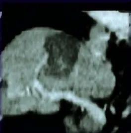 Coronal reconstructed image after treatment shows dark treated area without contrast enhancement in the area of the tumor. The dark area is coagulative necrosis, or dead cells.
