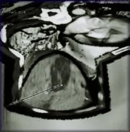 Three-dimensional reconstruction after ablation.